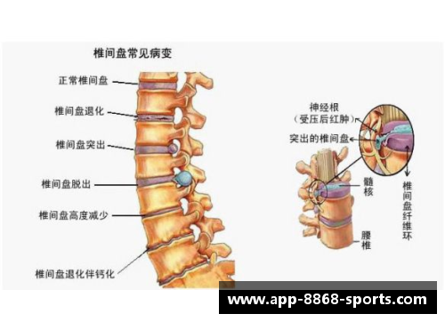 腰椎盘突出困扰下的体育明星们如何逆袭重返赛场的励志故事